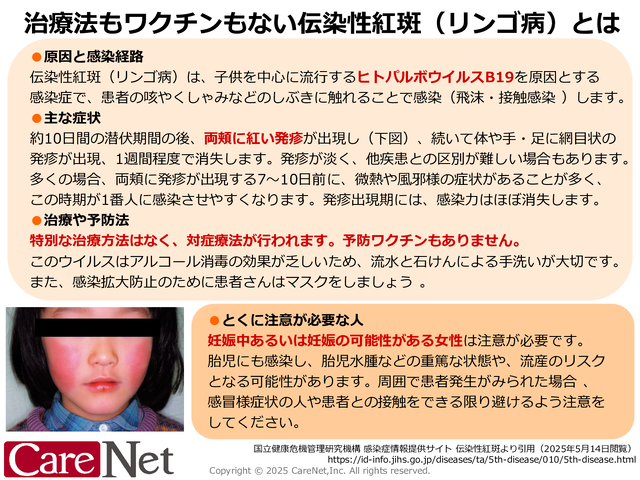 成人女性は注意したい伝染性紅斑（リンゴ病）