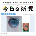 爪甲中枢側部に黒色調色素沈着がみられる。診断名は？