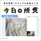 頭皮に点状出血、長さの異なる毛髪を認める。診断名は？