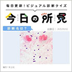 60代・男性。39.2℃の発熱後、体動時に息苦しさ出現。診断は？