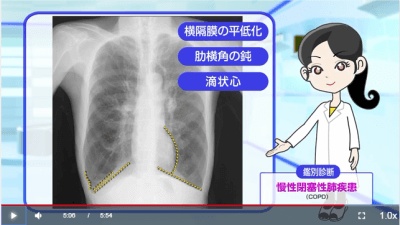 Dr.長尾の胸部X線クイズ　初級編【第1回　場所が言えなきゃ始まらない】